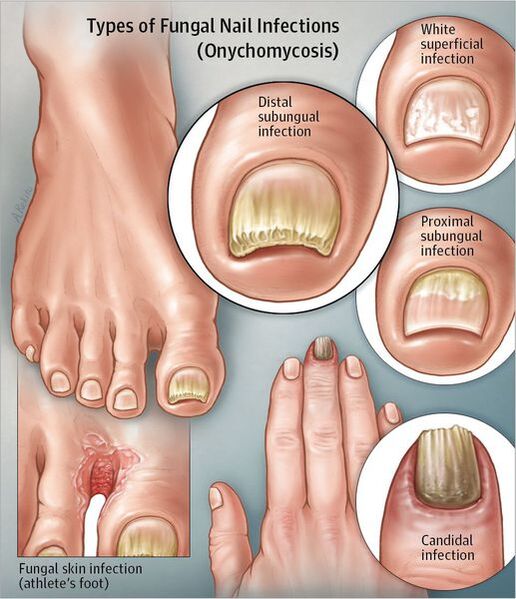 stadiile dezvoltării ciupercii unghiilor de la picioare